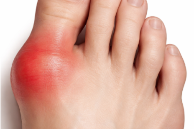 Red, Hot and Swollen Foot - You may have Gout The British Foot Doc’s guide to Gout