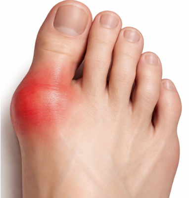 Red, Hot and Swollen Foot - You may have Gout The British Foot Doc’s guide to Gout